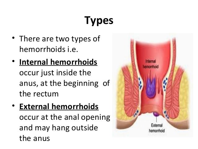 hemorrhoid outside the anus Gay video shat room